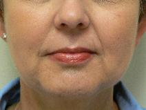 Hyaluronic Acid After